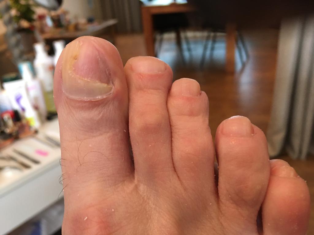 Schimmelnagel in een verder gevorderd stadium - Loslaten nagelplaat - Atrofie van de nagel - na de behandeling - Isabelle Viola - Medische Pedicure Appels benen