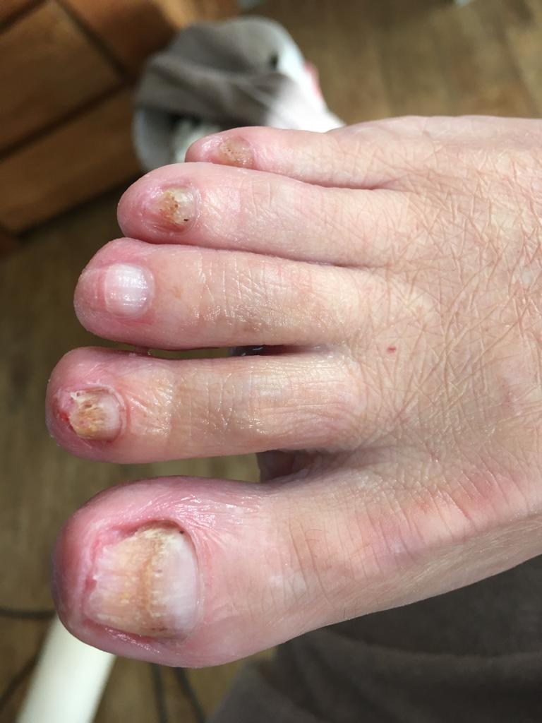 Schimmelnagels - na de behandeling - Isabelle Viola - Medische Pedicure Appels benen