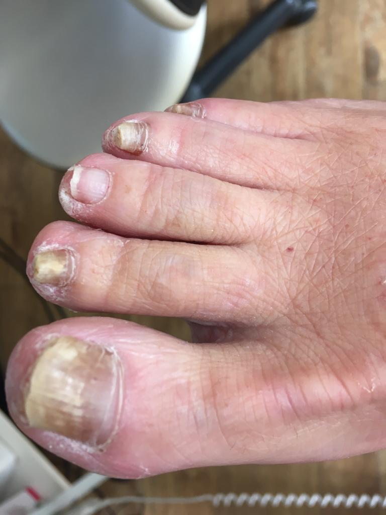 Schimmelnagels - voor de behandeling - Isabelle Viola - Medische Pedicure Appels benen
