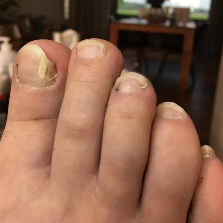 Onychomycose-Hoe-kom-je-van-een-kalknagel-af-voor-Isabelle-Viola-Medische-Pedicure-Dendermonde benen