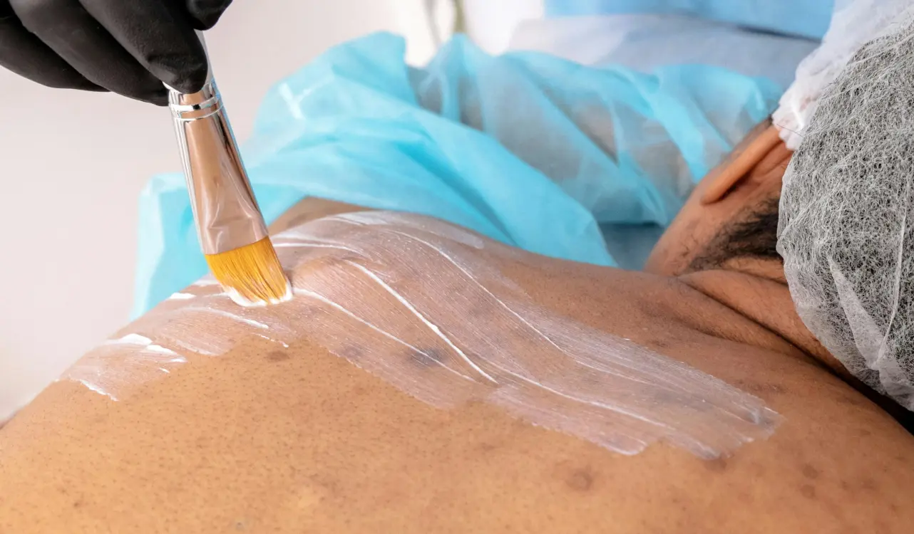 Acnebehandeling van de rug - Isabelle Viola massage gelaat